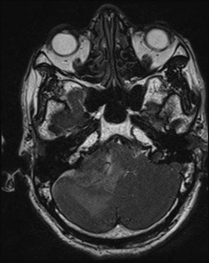 Acoustic schwannoma - probable (Radiopaedia 20386-20292 Axial T1 32).jpg