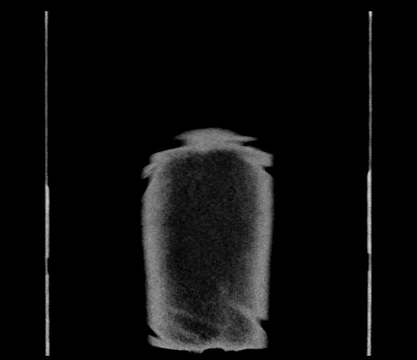 Acromioclavicular joint cyst (Radiopaedia 58455-65610 Coronal C+ arterial phase 151).jpg