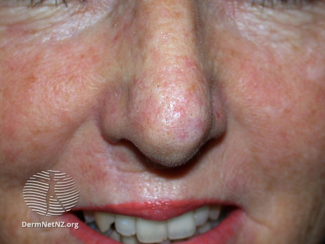 File:Actinic Keratoses treated with imiquimod (DermNet NZ lesions-ak-imiquimod-3753).jpg