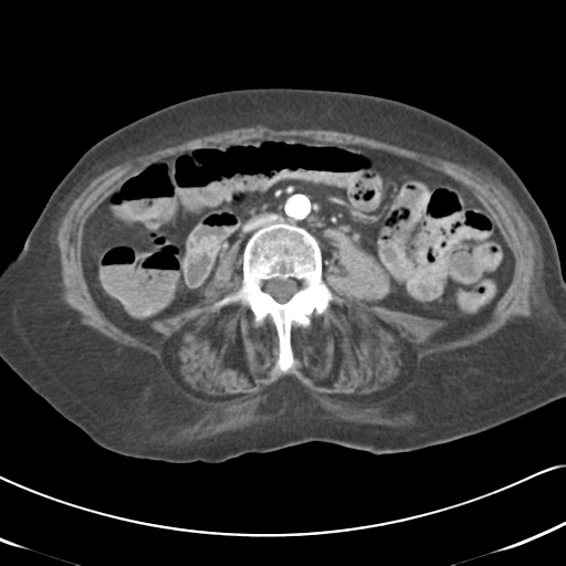 Active bleeding from duodenal ulcer with embolization (Radiopaedia 34216-35481 C 34).png