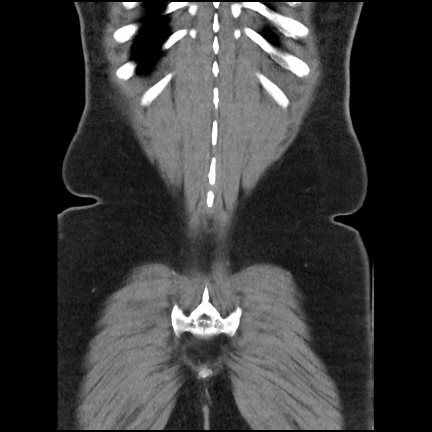 Active colonic bleed on CT (Radiopaedia 49765-55025 Coronal non-contrast 49).jpg