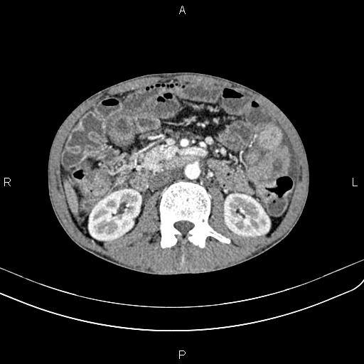 Active crohn disease (Radiopaedia 87133-103397 Axial C+ arterial phase 49).jpg