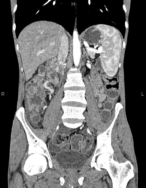 Active crohn disease (Radiopaedia 87133-103397 Coronal C+ arterial phase 37).jpg