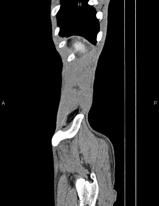 Active crohn disease (Radiopaedia 87133-103397 Sagittal C+ arterial phase 85).jpg