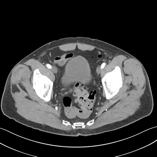 File:Active diverticular hemorrhage (Radiopaedia 39415-41725 Axial C+ arterial phase 61).png