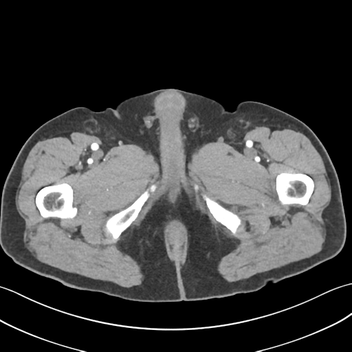 File:Active diverticular hemorrhage (Radiopaedia 39415-41725 Axial C+ arterial phase 81).png