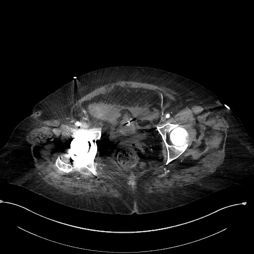 File:Active renal extravasation with large subcapsular and retroperitoneal hemorrhage (Radiopaedia 60975-68796 Axial 144).jpg