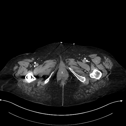Active renal extravasation with large subcapsular and retroperitoneal hemorrhage (Radiopaedia 60975-68796 Axial C+ arterial phase 214).jpg