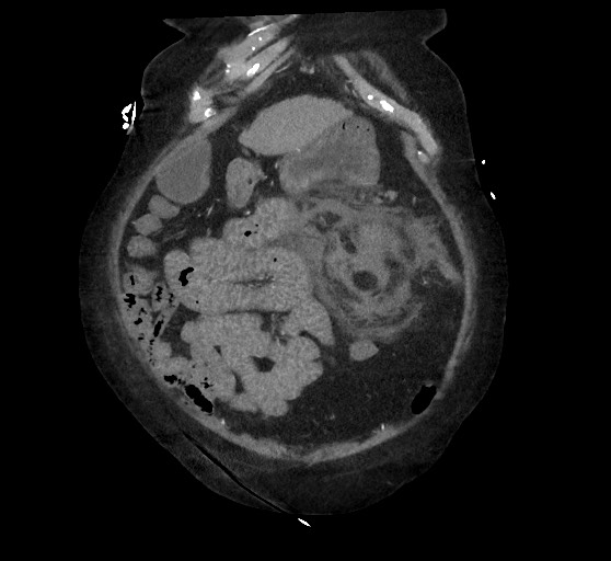 Active renal extravasation with large subcapsular and retroperitoneal hemorrhage (Radiopaedia 60975-68796 Coronal C+ arterial phase 38).jpg