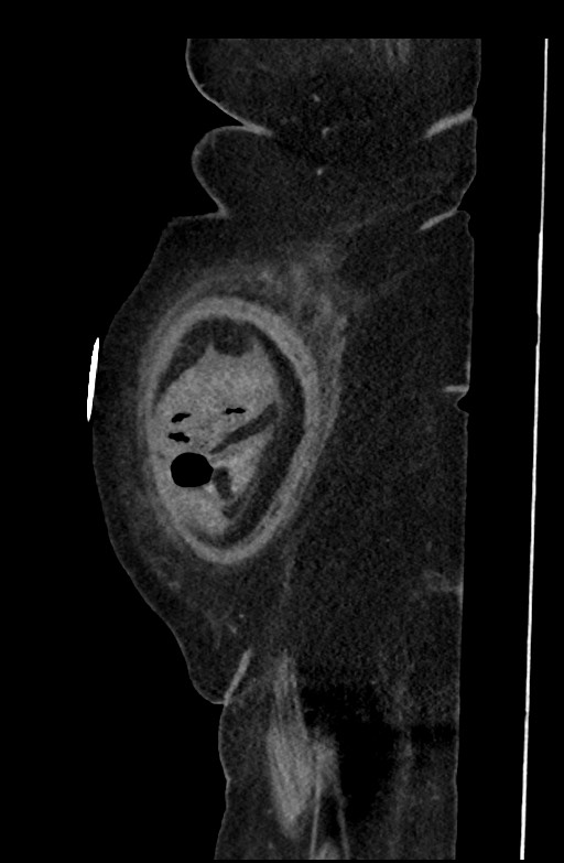 Active renal extravasation with large subcapsular and retroperitoneal hemorrhage (Radiopaedia 60975-68796 Sagittal C+ portal venous phase 198).jpg