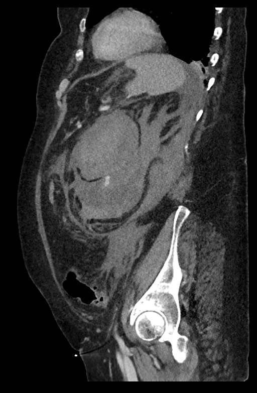 Active renal extravasation with large subcapsular and retroperitoneal hemorrhage (Radiopaedia 60975-68796 Sagittal C+ portal venous phase 74).jpg