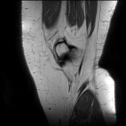 Acute-on-chronic transient lateral patellar dislocation with trochlear dysplasia (Radiopaedia 84099-99349 Sagittal PD 23).jpg