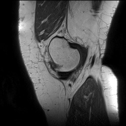 File:Acute-on-chronic transient lateral patellar dislocation with trochlear dysplasia (Radiopaedia 84099-99349 Sagittal PD 33).jpg