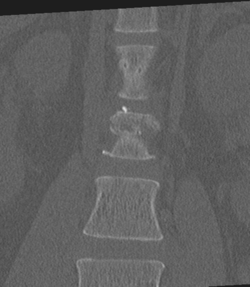 File:Acute L1 burst compression fracture (Radiopaedia 34430-35755 Coronal bone window 14).png