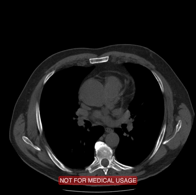 Acute aortic dissection - Stanford type A (Radiopaedia 40661-43285 Axial non-contrast 28).jpg