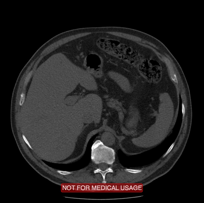 Acute aortic dissection - Stanford type A (Radiopaedia 40661-43285 Axial non-contrast 77).jpg