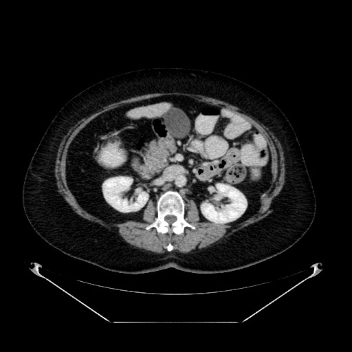 Acute appendicitis, heterotaxy syndrome (Radiopaedia 66884-76202 Axial C+ portal venous phase 53).jpg