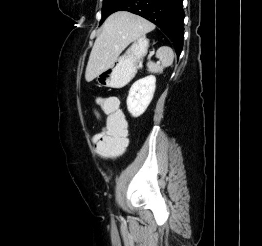 Acute appendicitis, heterotaxy syndrome (Radiopaedia 66884-76202 Sagittal C+ portal venous phase 42).jpg