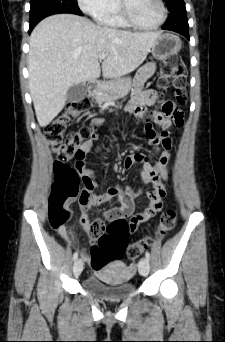 Acute appendicitis (Radiopaedia 22892-22918 Coronal C+ portal venous phase 17).png