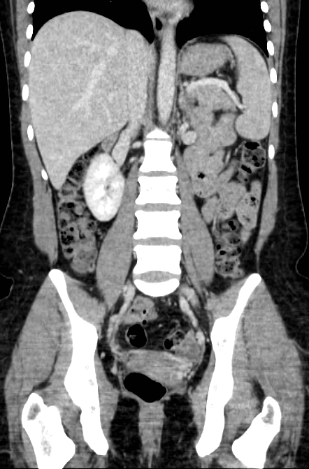 Acute appendicitis (Radiopaedia 22892-22918 Coronal C+ portal venous phase 32).png