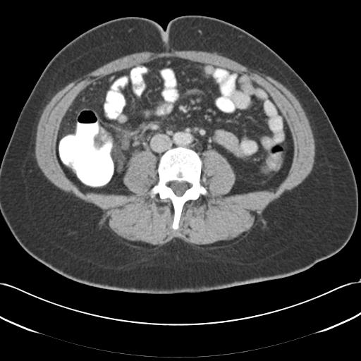 Acute appendicitis (Radiopaedia 30297-30934 Axial C+ portal venous phase 46).jpg