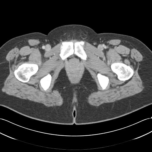 Acute appendicitis (Radiopaedia 30297-30934 Axial C+ portal venous phase 84).jpg