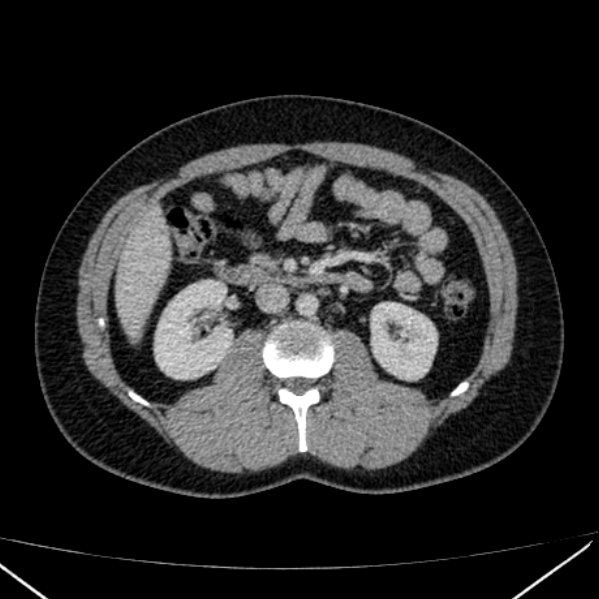Acute appendicitis (Radiopaedia 38255-40270 Axial C+ portal venous phase 45).jpg