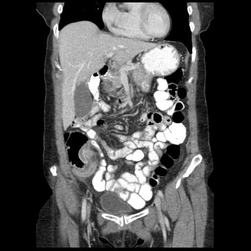 File:Acute appendicitis (Radiopaedia 52672-58589 Coronal C+ portal venous phase 23).jpg