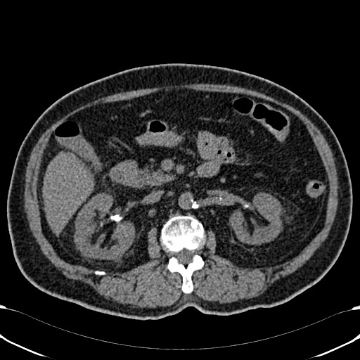 File:Acute appendicitis (Radiopaedia 58627-65818 Axial non-contrast 36).jpg