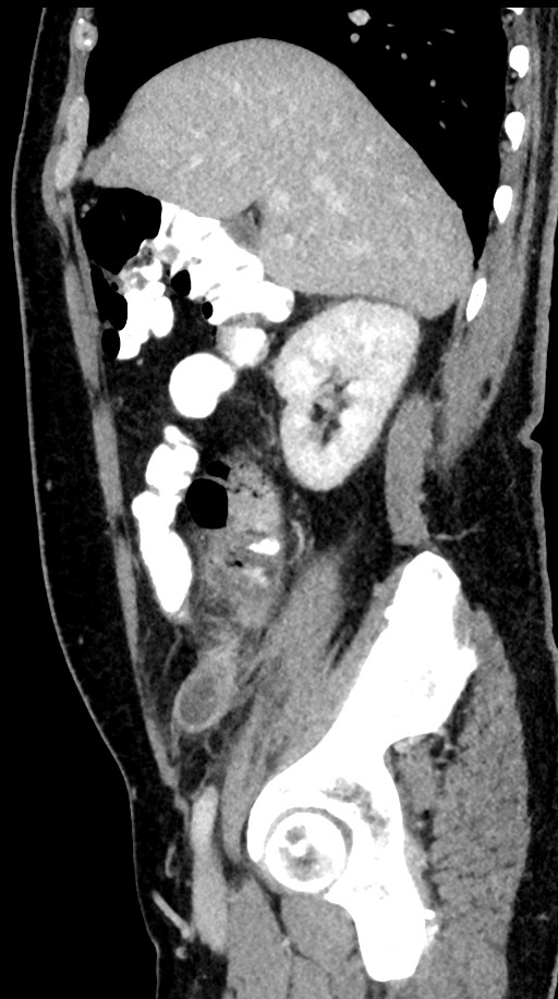 Acute appendicitis (Radiopaedia 77016-88960 Sagittal C+ portal venous phase 81).jpg