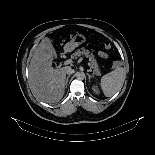 Acute appendicitis (Radiopaedia 79950-93224 Axial non-contrast 30).jpg