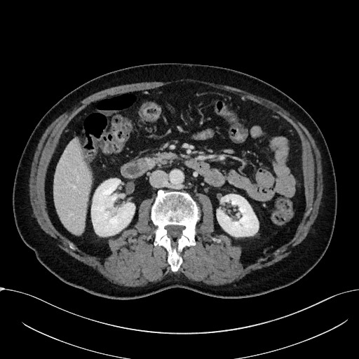 Acute appendicitis - large appendicoliths (Radiopaedia 61805-69820 Axial C+ portal venous phase 56).jpg