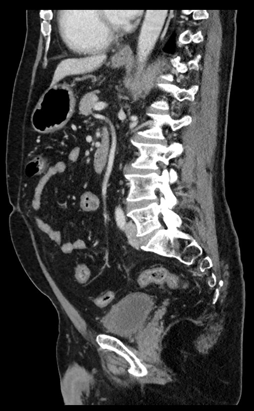 Acute appendicitis - large appendicoliths (Radiopaedia 61805-69820 Sagittal C+ portal venous phase 51).jpg