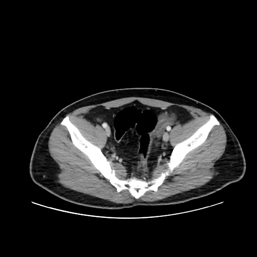 Acute appendicitis and COVID 19 pneumonia (Radiopaedia 76604-88380 Axial C+ portal venous phase 70).jpg