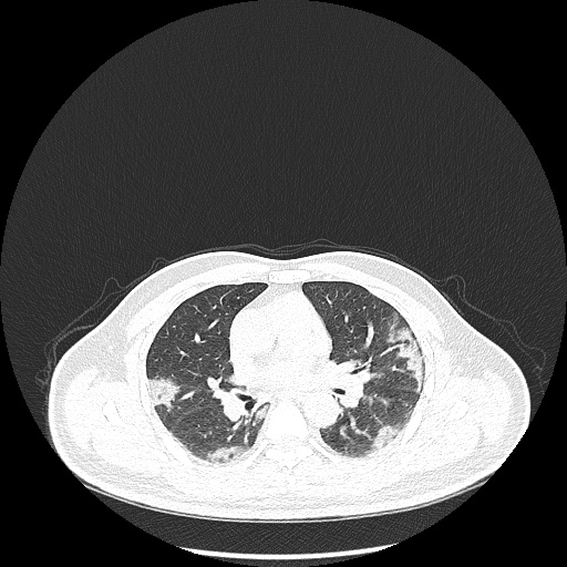 Acute appendicitis and COVID 19 pneumonia (Radiopaedia 76604-88380 Axial lung window 26).jpg