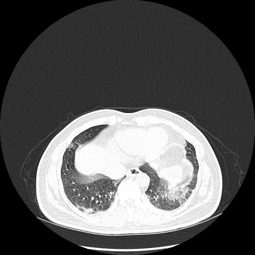 Acute appendicitis and COVID 19 pneumonia (Radiopaedia 76604-88380 Axial lung window 43).jpg