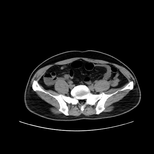 Acute appendicitis and COVID 19 pneumonia (Radiopaedia 76604-88380 Axial non-contrast 96).jpg