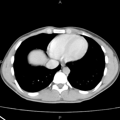 File:Acute appendicitis with CT arrowhead sign (Radiopaedia 21474-21411 Axial C+ portal venous phase 1).jpg