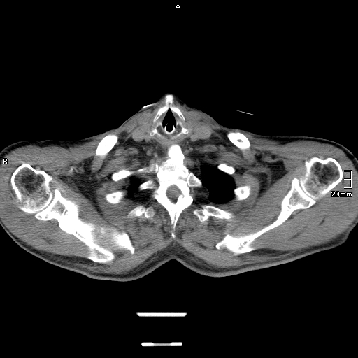 Acute aspiration pneumonitis (Radiopaedia 55642-62166 Axial liver window 7).jpg