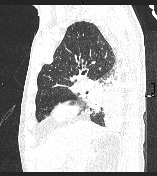 File:Acute aspiration pneumonitis (Radiopaedia 55642-62166 Sagittal lung window 99).jpg