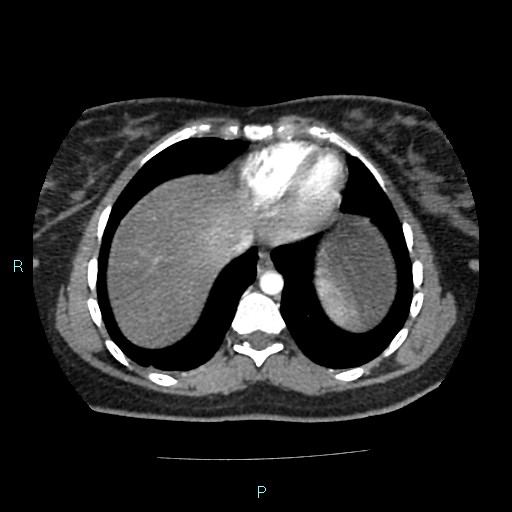 File:Acute bilateral pyelonephritis (Radiopaedia 37146-38881 Axial C+ arterial phase 9).jpg