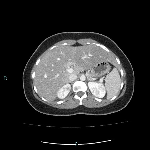 File:Acute bilateral pyelonephritis (Radiopaedia 37146-38881 Axial C+ portal venous phase 27).jpg