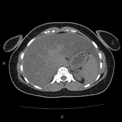 Acute bilateral pyelonephritis (Radiopaedia 37146-38881 Axial non-contrast 23).jpg