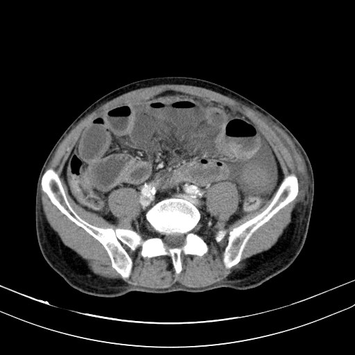 Acute bowel ischemia (Radiopaedia 87695-104114 Axial C+ portal venous phase 59).jpg