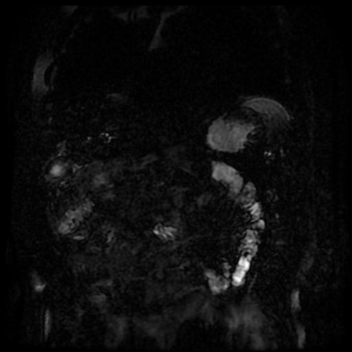 Acute cholecystitis and biliary hamartomas (Radiopaedia 86231-102240 E 127).jpg