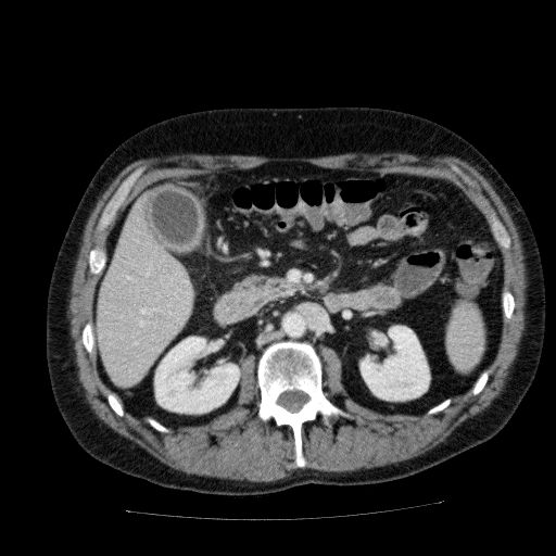 Acute cholecystitis and incidental left sided IVC (Radiopaedia 49352-54459 Axial C+ portal venous phase 65).jpg