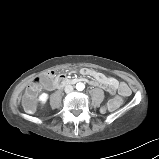 Acute cholecystitis with contained perforation (Radiopaedia 47328-51907 Axial C+ portal venous phase 42).png