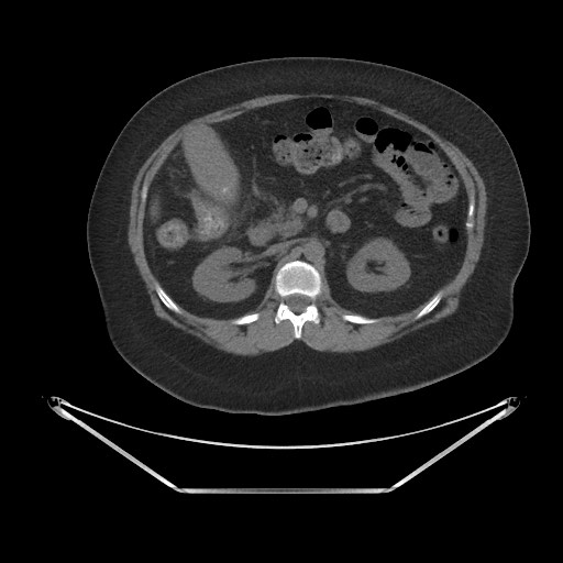Acute cholecystitis with tensile fundus sign (Radiopaedia 71394-81723 Axial non-contrast 29).jpg