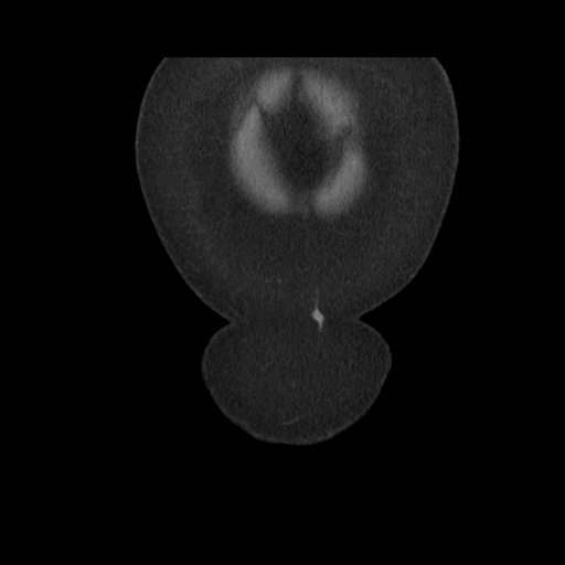 Acute cholecystitis with tensile fundus sign (Radiopaedia 71394-81723 Coronal non-contrast 17).jpg