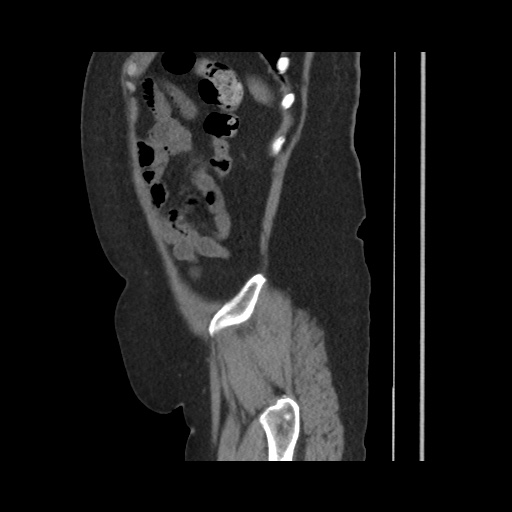 Acute cholecystitis with tensile fundus sign (Radiopaedia 71394-81723 Sagittal non-contrast 139).jpg